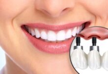 Dental Implants