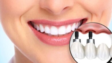 Dental Implants