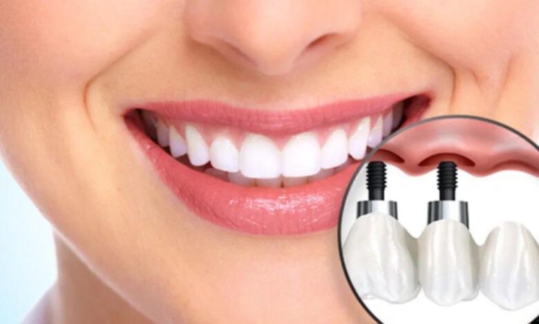 Dental Implants